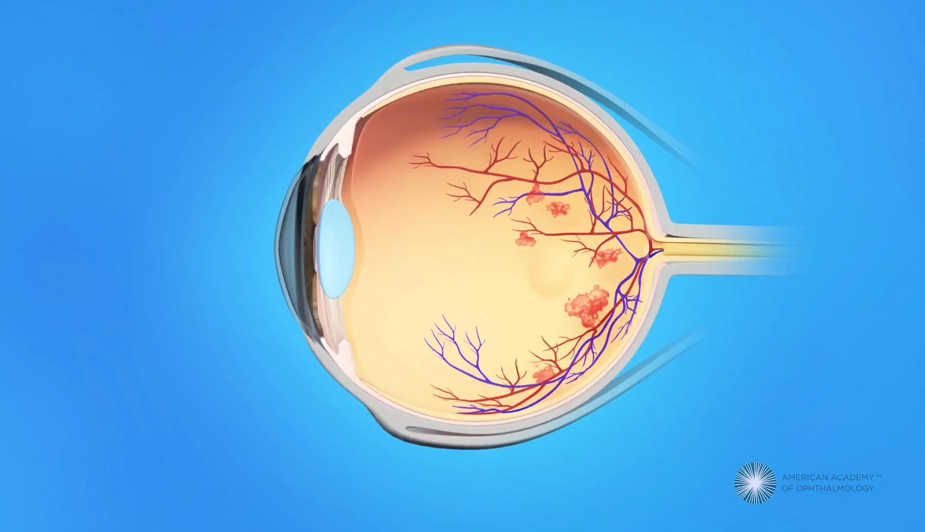 晴報：突然眼前一黑是眼中風？