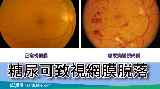 信報：糖尿可致視網膜脫落