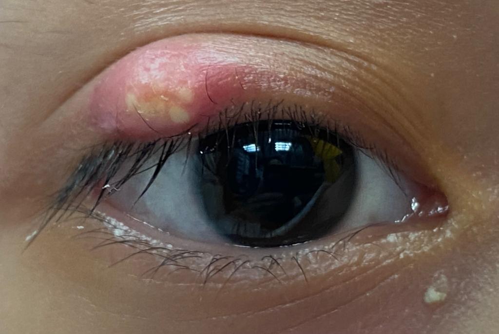 晴報：熱敷眼睛正確方法