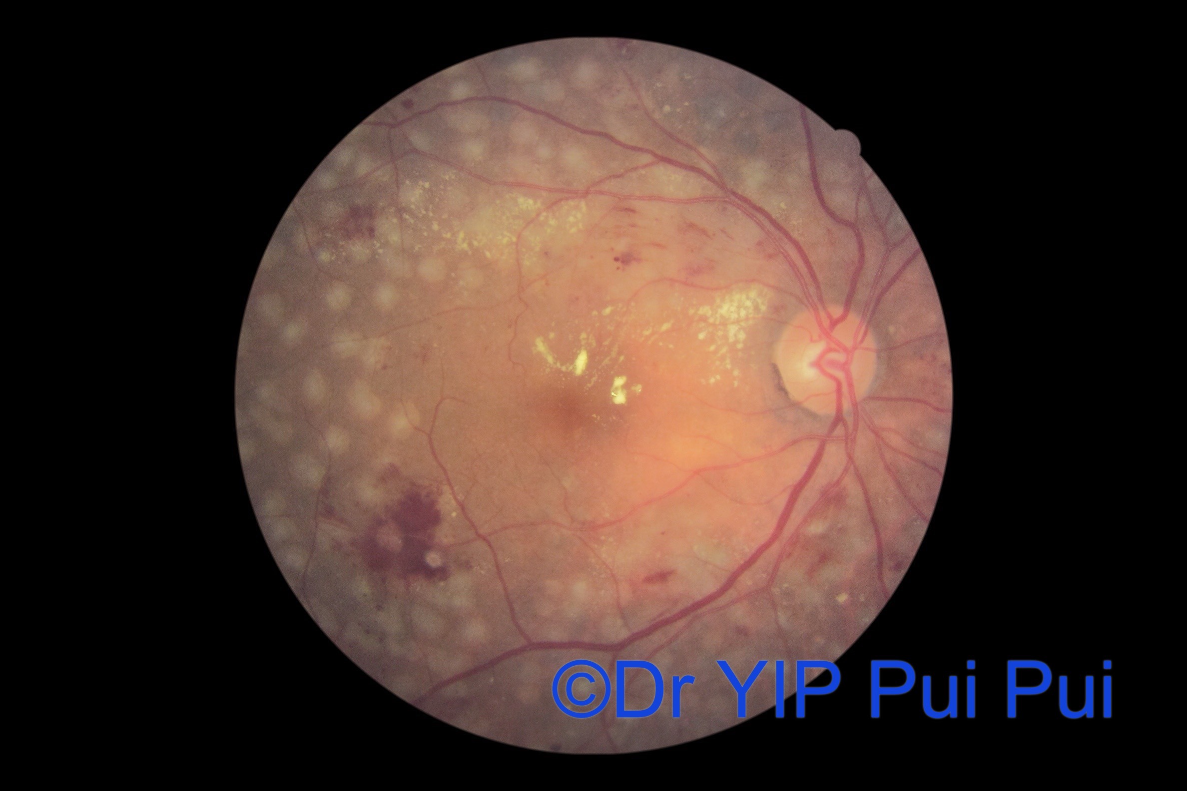 信報：糖尿上眼點樣醫