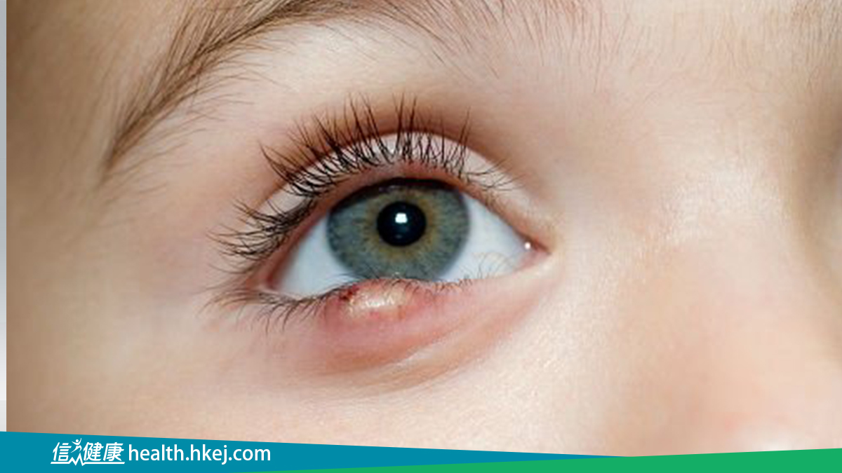 信報：為何生眼瘡？