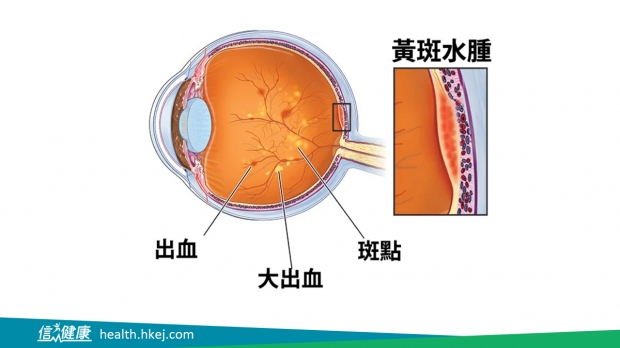 信報：糖尿性黃斑水腫