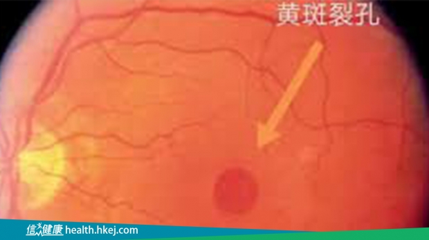 黃斑裂孔