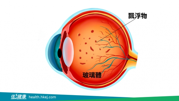 信報：飛蚊症有藥醫治？