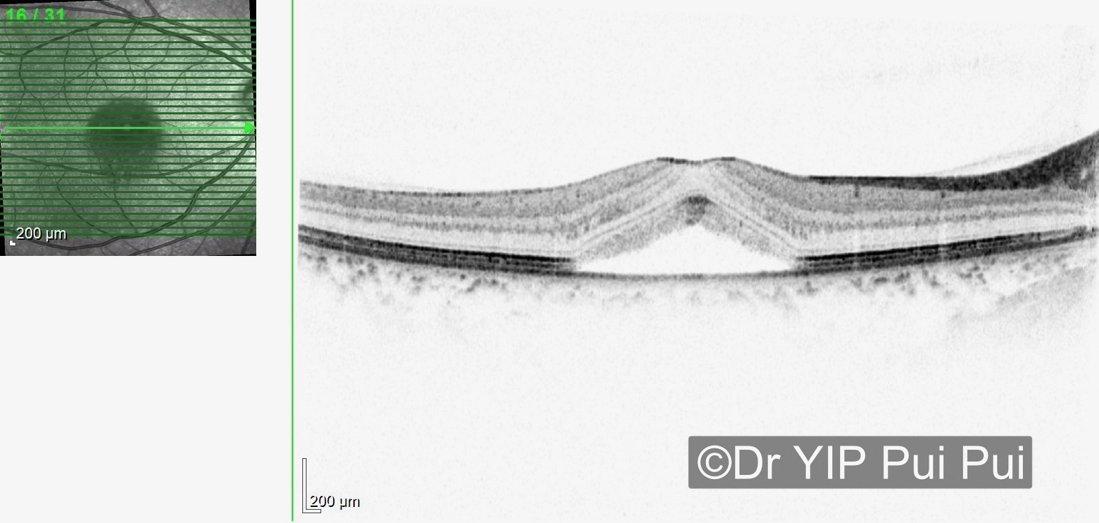 信報：大壓力易患視網膜病變